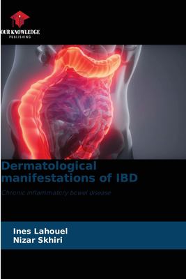Dermatological manifestations of IBD: Chronic inflammatory bowel ...