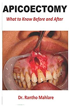 APICOECTOMY: What to Know Before and After book by Dr. Rantho Mahlare ...